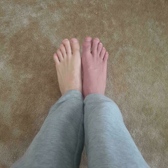 My Feet A Month After A Knee Surgery