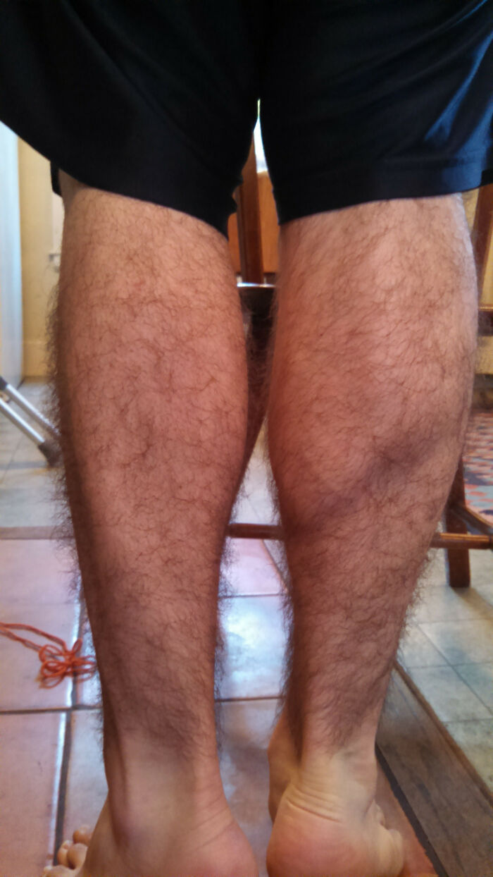 My Right Calf Really Picked Up The Slack Following A Leg Surgery- Two Months Of Non-Weight-Bearing