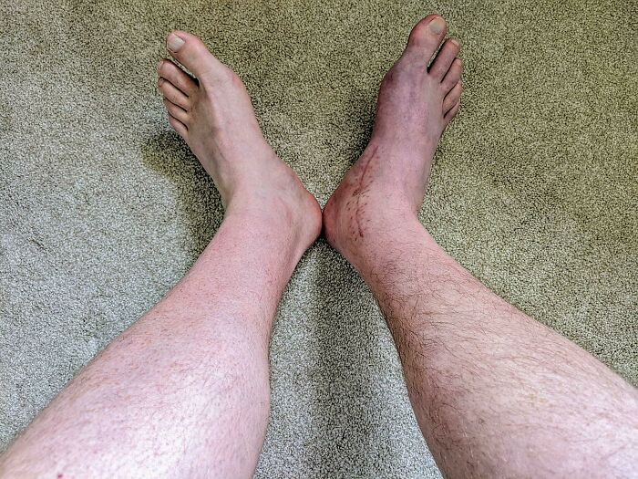 Recently Dislocated And Broke My Ankle. While Healing, The Leg With The Injury Is Growing Significantly More Hair