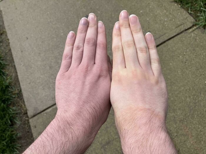 The Color Difference In My Hands After Donating Blood