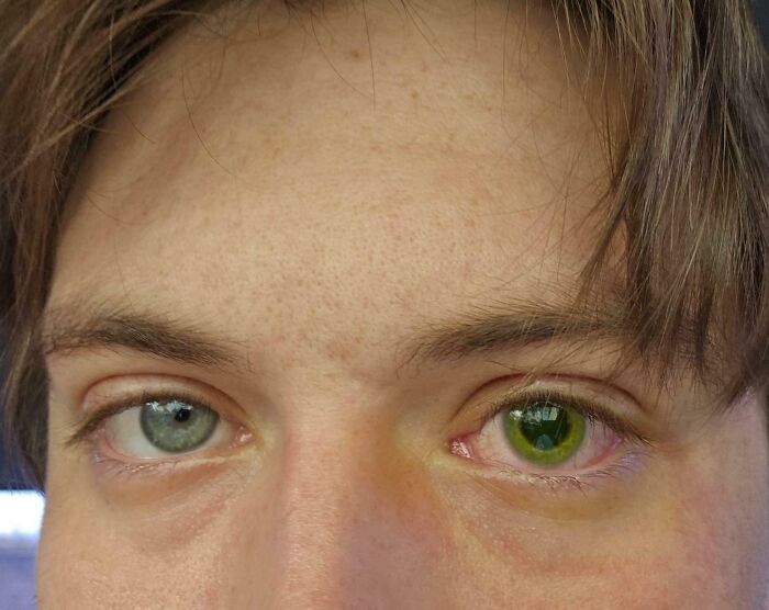 Right Eye Changed Color After Surgery