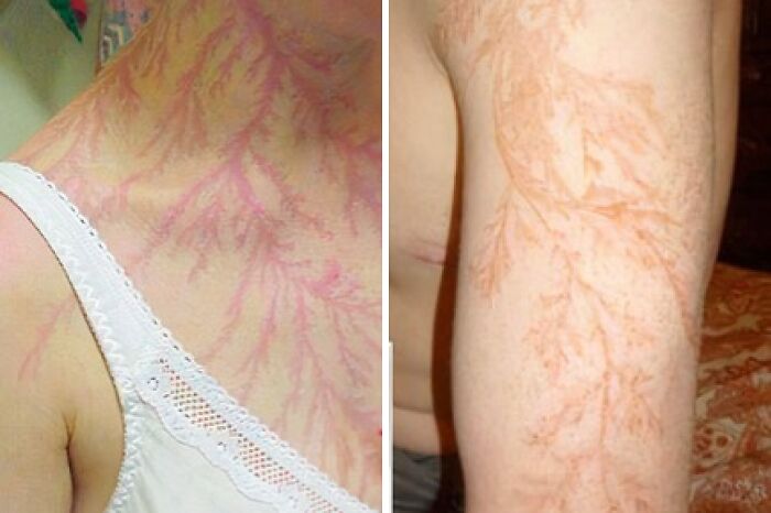 The Scars On The Bodies Of Those Who Survived A Lightning Strike