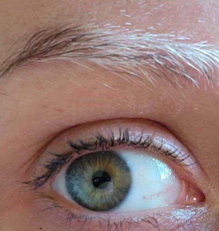 One Of My Eyebrows Has Been Turning White. No Other Hair Is Doing This