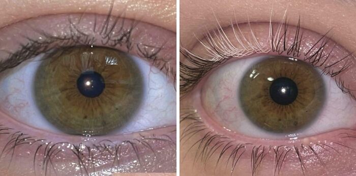 One Year Ago Today I Saw I Had A Singular White Eyelash And Now It's CA. 20% Of Lashes On My Right Eye