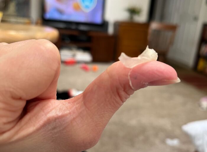 I Survived Toxic Shock Syndrome And Now My Skin Is Peeling Off