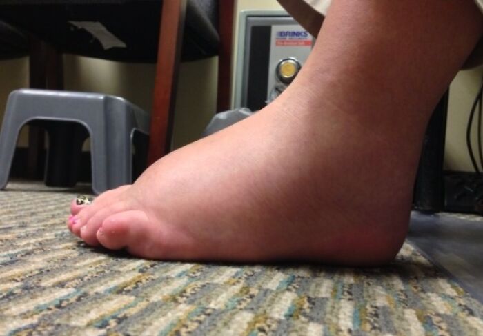 My Pregnant Friend's Feet Are A Bit Swollen Today