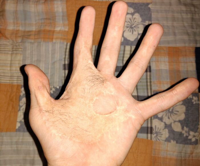Burnt My Hand With An Iron At Age 1.5 This Is My Hand Almost 14 Years Later. Yes That Is Hair On My Hand