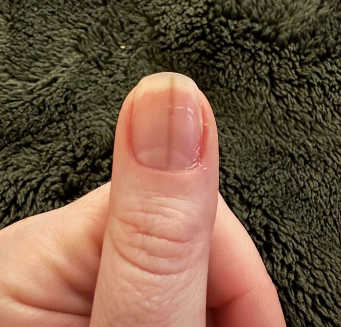 Dark Tan Line Showed Up On My Thumb Nail, Won’t Go Away
