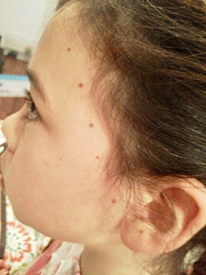 My Daughter’s Freckles Are In A Straight Line