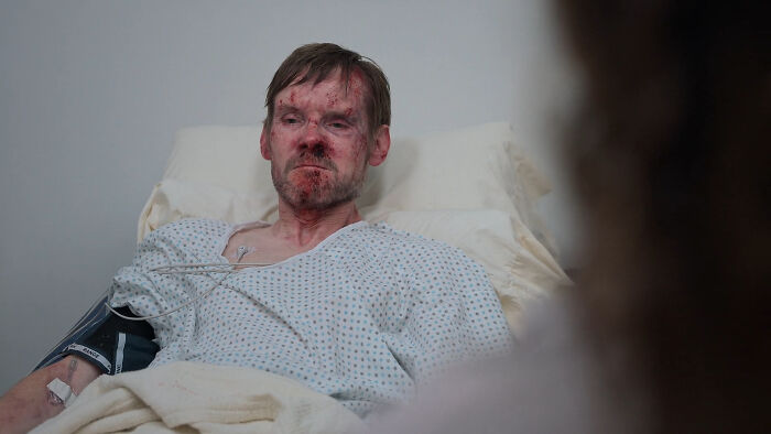 Man with facial injuries wearing hospital gown lying in bed, scene from The Pitt Season 2 Episode 6 guest cast appearance. - 3