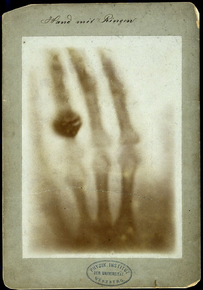 Victorian Era X-ray photo showing bones of a hand with a ring, one of the earliest medical images from the period.