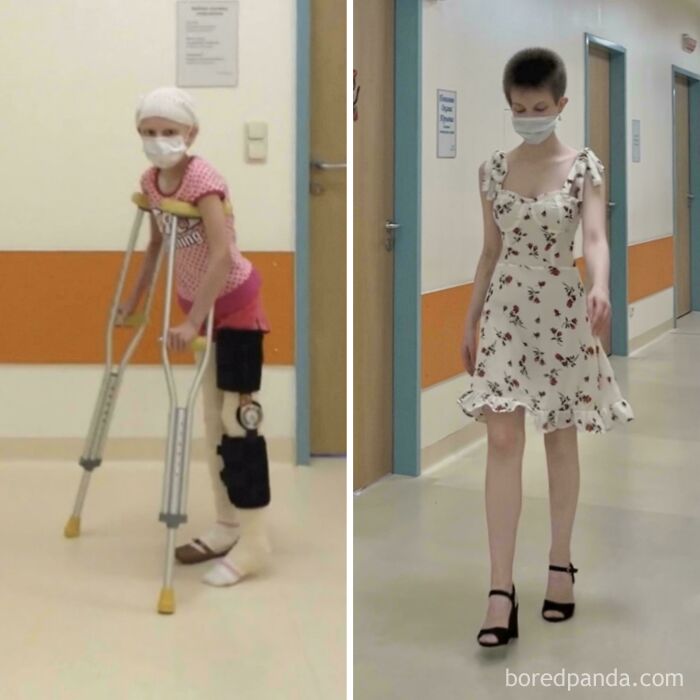 Young girl recovering and walking confidently in a hospital hallway