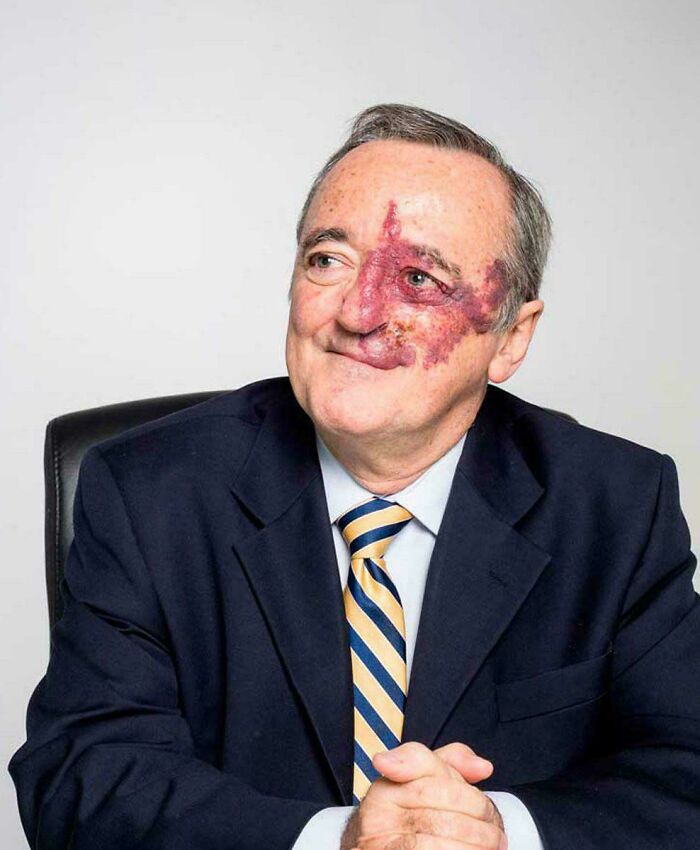 A man with an interesting birthmark on his face, wearing a suit and smiling, truly a d**n interesting photo.