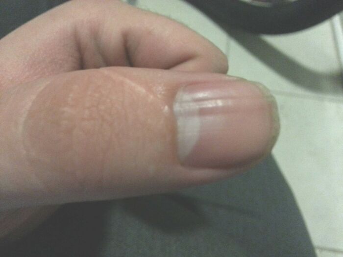 Scar Changed How My Thumb Nail Grows