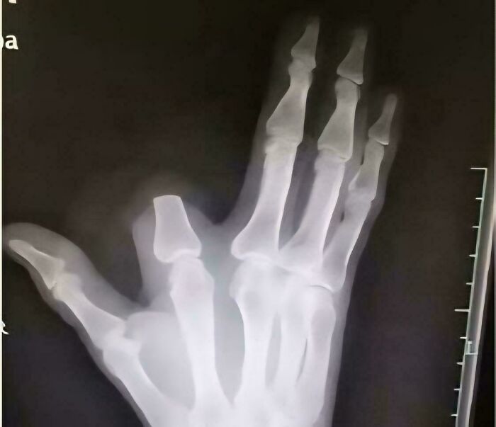 X-ray image showcasing fascinating pics of a hand bone structure, offering a quick brain boost with anatomical facts.