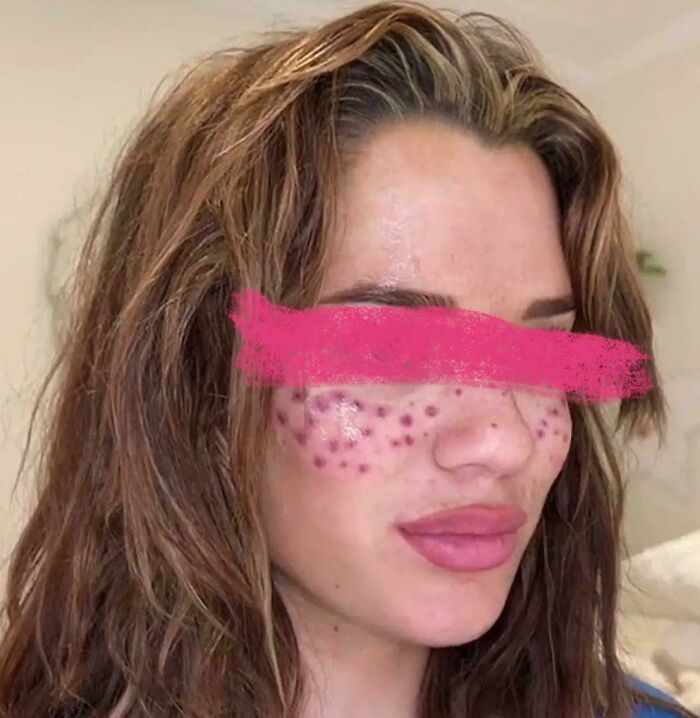 Woman with unusual truly awful tattoos resembling red dots across her cheeks, highlighting a tragic and permanent face tattoo trend.