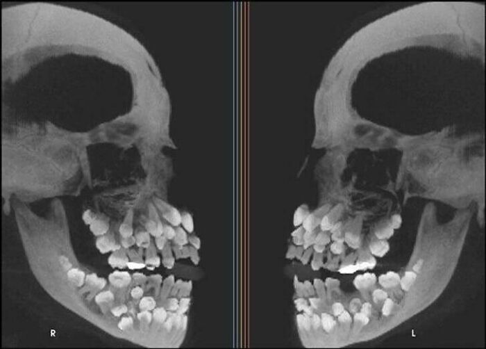 X-ray image showing an unusual dental condition with multiple teeth inside the jaw, illustrating unreal photos of reality.