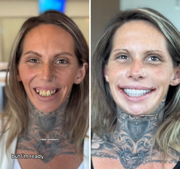 Before and after dental work transformation showing a woman smiling confidently with improved teeth and dental implants.