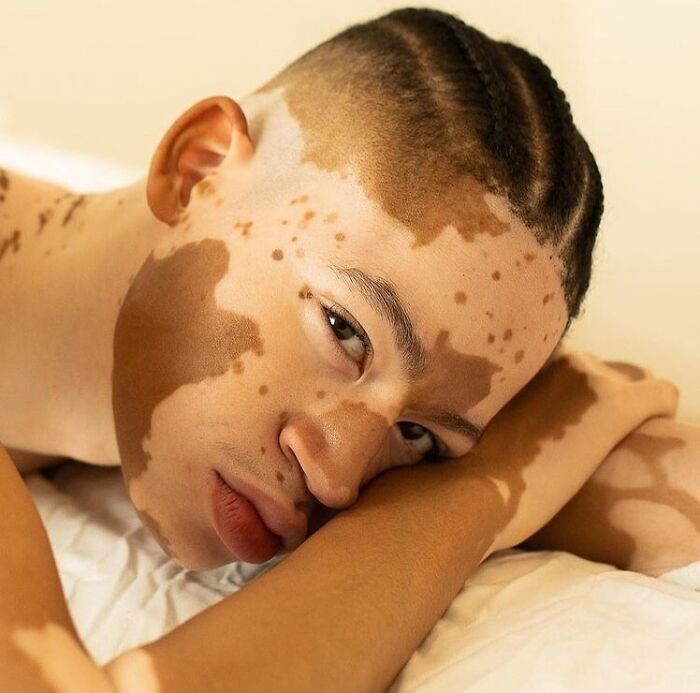 These People With Vitiligo Are Turning Their Skin Into Living Art (35 Pics)