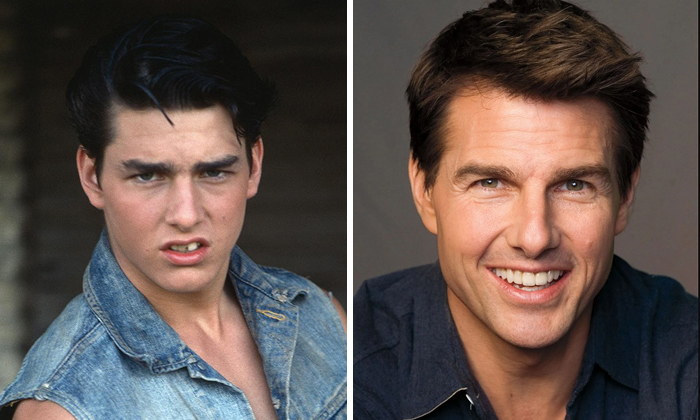 Tom Cruise Before and after photos of a celebrity showcasing the transformation with dental implant makeovers and improved smile.