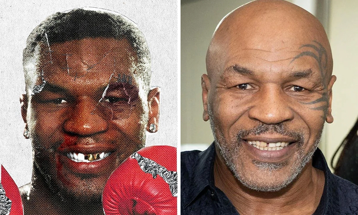 Mike Tyson Before and after celebrity dental implant makeover showing improved smile and dental transformation from gaps to glam.