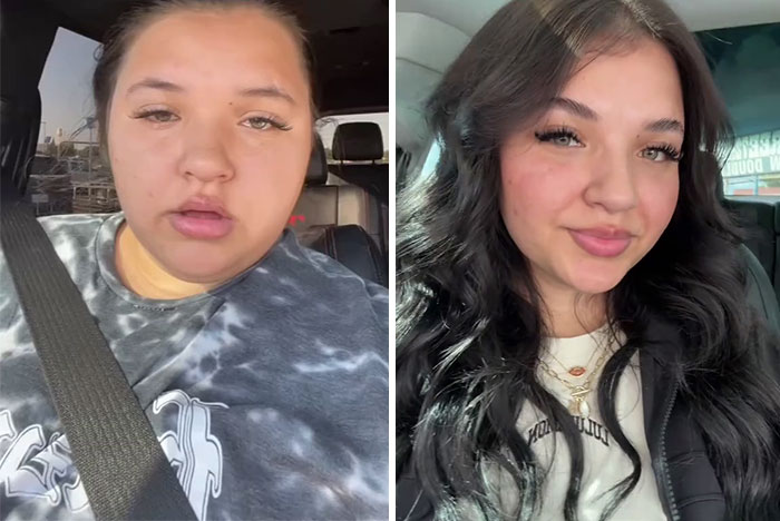 Side-by-side photos showing dramatic facial changes from an Ozempic journey highlighting Ozempic face transformation.