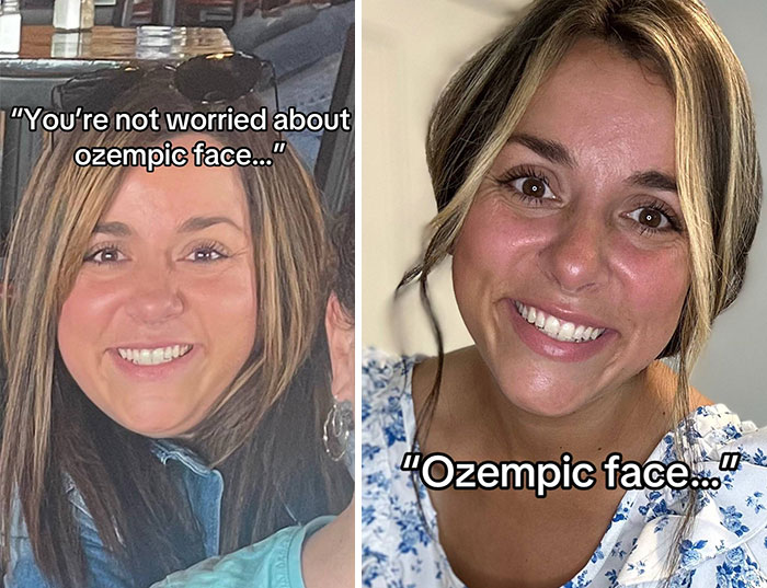 Before and after photos showing dramatic facial changes from the Ozempic face transformation journey.