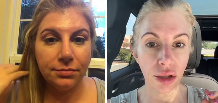 Side-by-side before and after photos showing dramatic facial changes from the Ozempic face transformation journey.