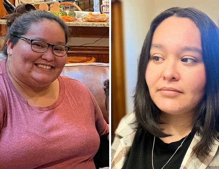 Side-by-side photos showing dramatic facial changes in a woman during her Ozempic journey and Ozempic face transformation.