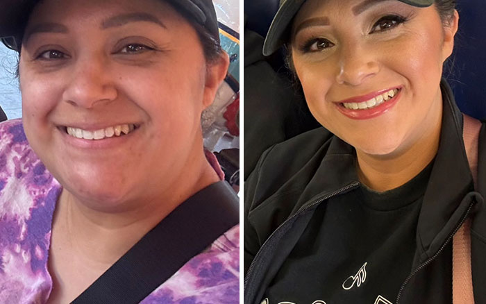 Side-by-side photos of a woman showing dramatic facial changes during her Ozempic journey with noticeable slimming.