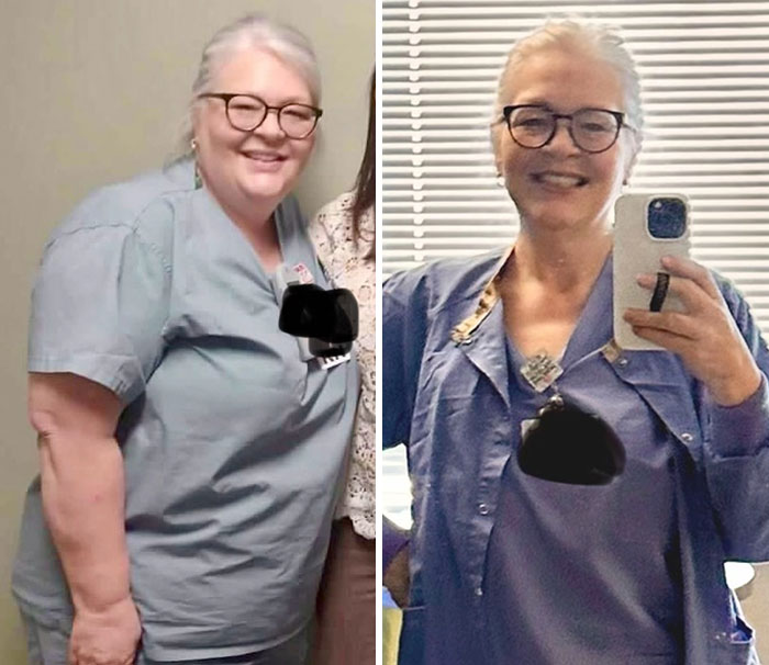 Before and after photos showing dramatic facial changes and weight loss in a woman’s Ozempic face transformation journey.