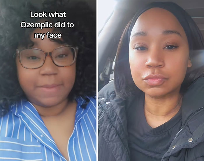 Before and after photos of a woman showing dramatic facial changes from her Ozempic face journey.