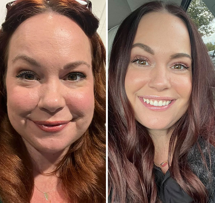 Before and after photos showing dramatic facial changes from the Ozempic face transformation journey.