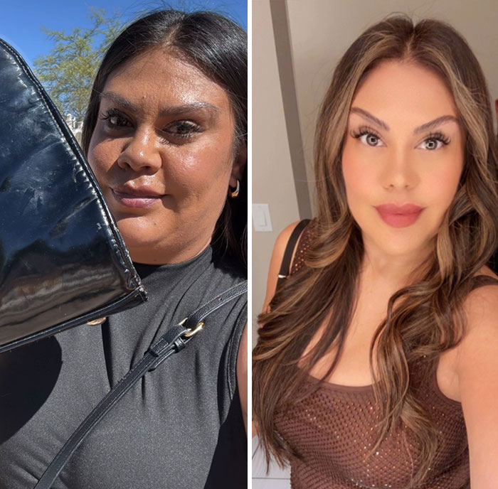 Before and after photos showing dramatic facial changes on a woman during her Ozempic face transformation journey.