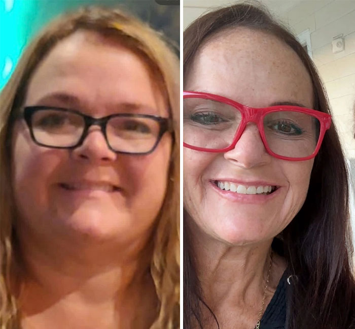 Side-by-side photos showing dramatic facial changes in a woman during her Ozempic face weight loss journey.