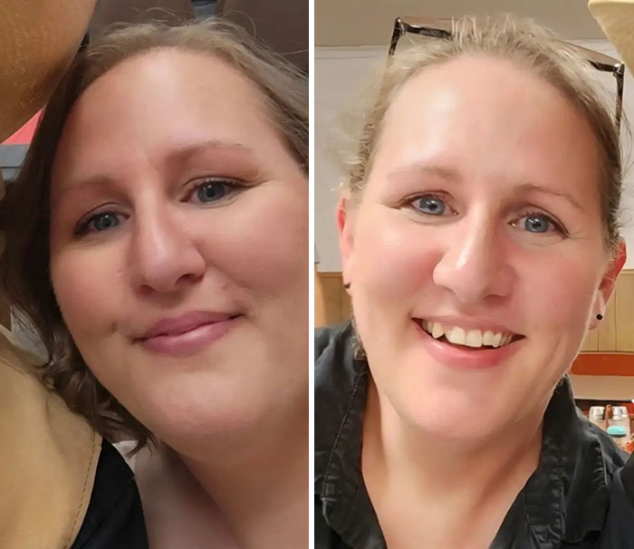 Side-by-side photos showing dramatic facial changes from an Ozempic journey with noticeable slimming effects.