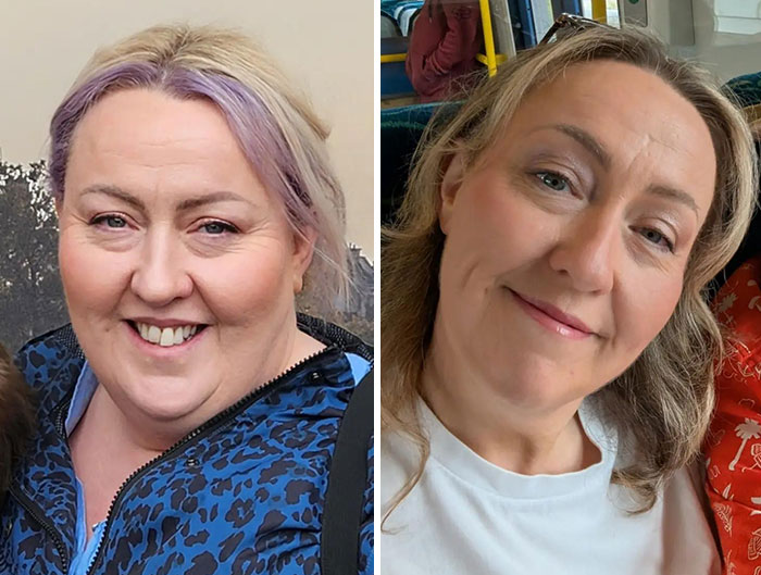 Before and after photos showing dramatic facial changes during an Ozempic journey with noticeable slimming effects.