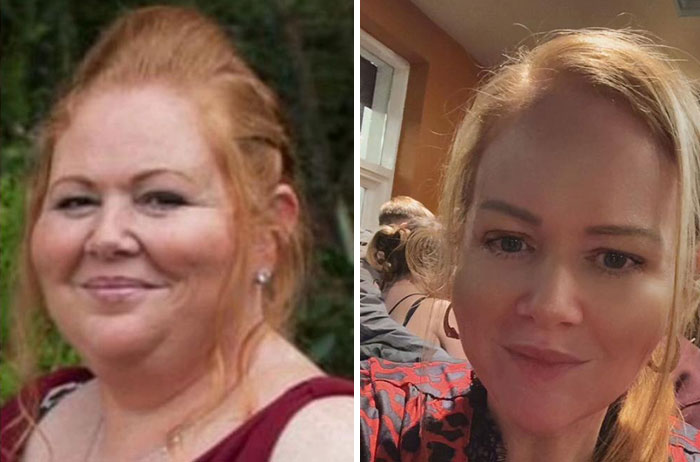 Before and after photos showing dramatic facial changes from an Ozempic face transformation journey.