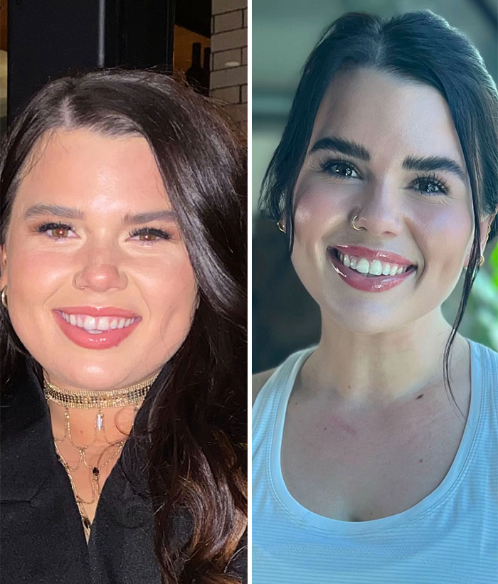 Side-by-side photos showing dramatic facial changes from Ozempic face transformation journey in two women.