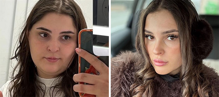 Side-by-side photos showing dramatic facial changes in a woman during her Ozempic weight loss journey.