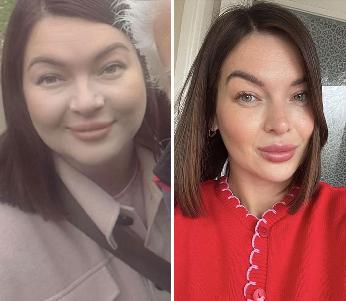 Side-by-side photos showing dramatic facial changes during an Ozempic journey with noticeable weight loss effects.