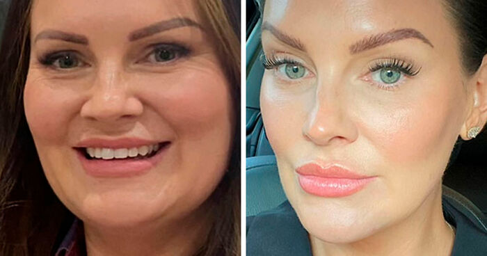 “I’ll Take Ozempic Face”: 77 People Share The Dramatic Facial Changes That Came With Their Ozempic Journey