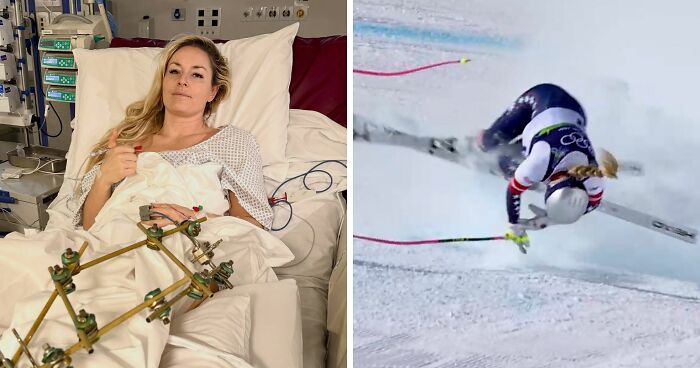 Major Update On Olympian Lindsey Vonn After Horrific Crash That May Cost Her A Leg