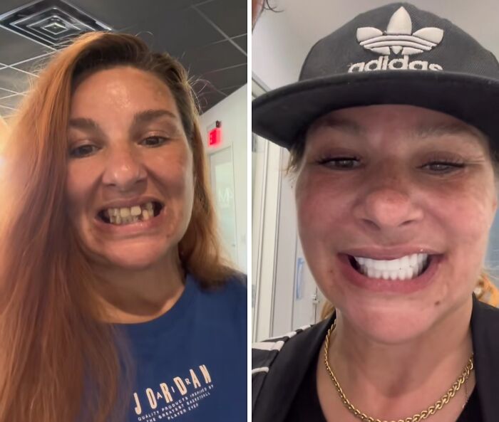 Before and after dental work showing a woman’s smile transformation with improved teeth and confidence.