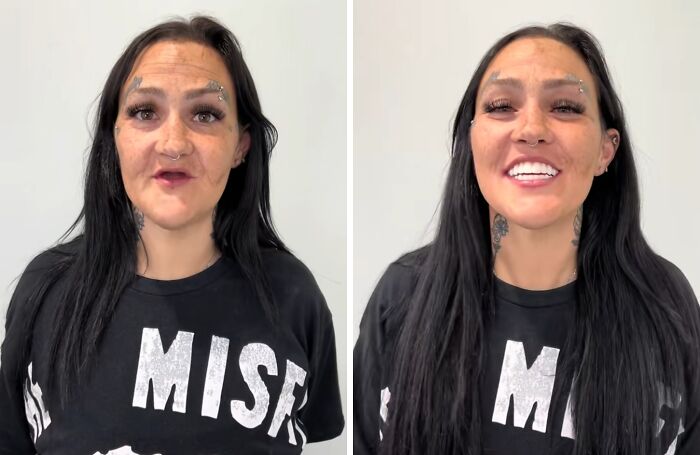 A woman before and after dental work showing a confident smile that highlights successful dental transformation.