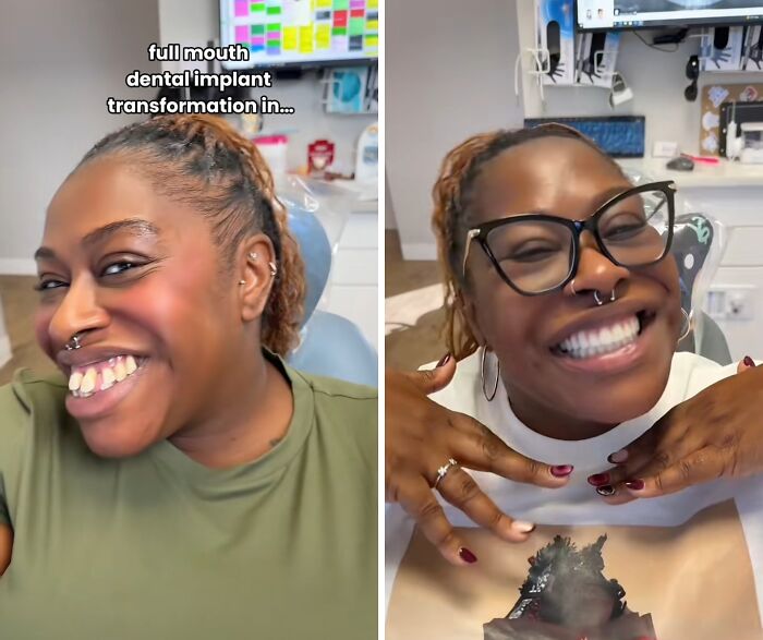 Before and after images of a woman smiling proudly showing her full mouth dental implant transformation.
