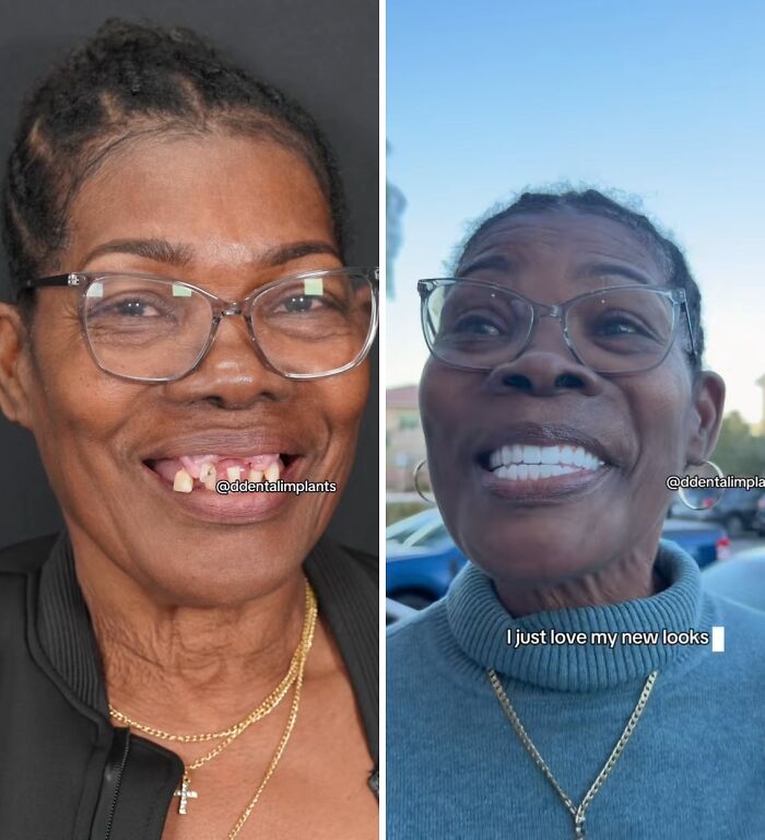 Before and after dental work transformation showing a woman smiling confidently with new teeth that made her smile without hesitation.