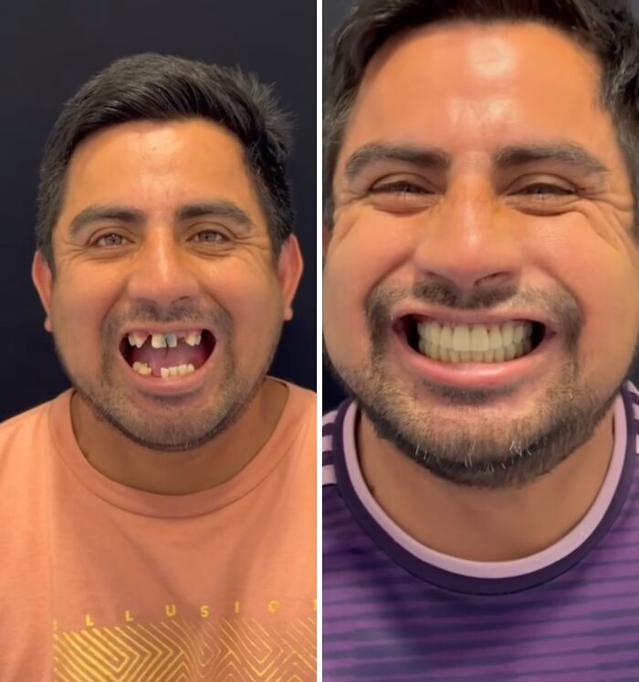 Before and after dental work transformation showing improved teeth and a confident smile without hesitation or shame.