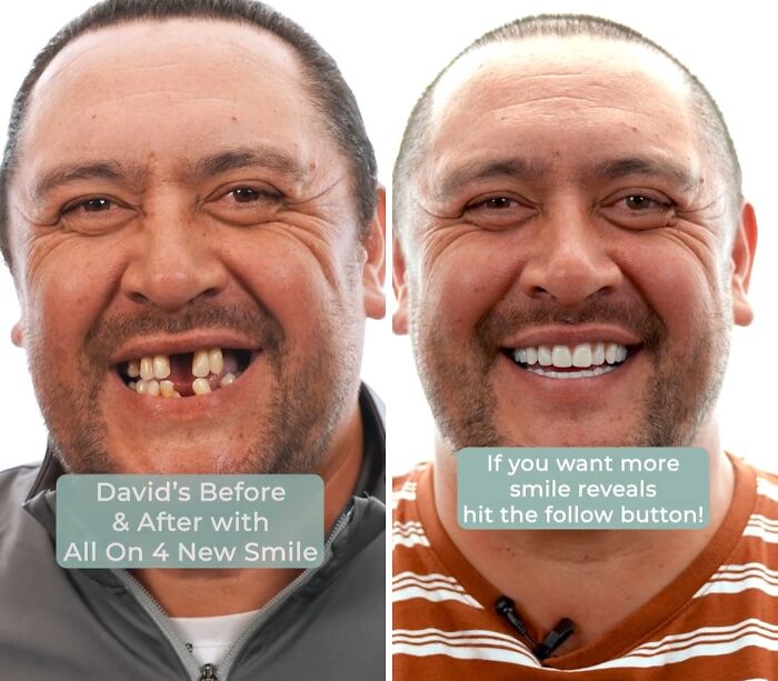 Man showing dental work transformation before and after All On 4 new smile, smiling confidently without hesitation or shame