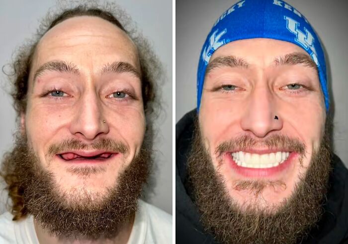 Before and after dental work showing a man smiling confidently with a full set of teeth and no hesitation or shame.